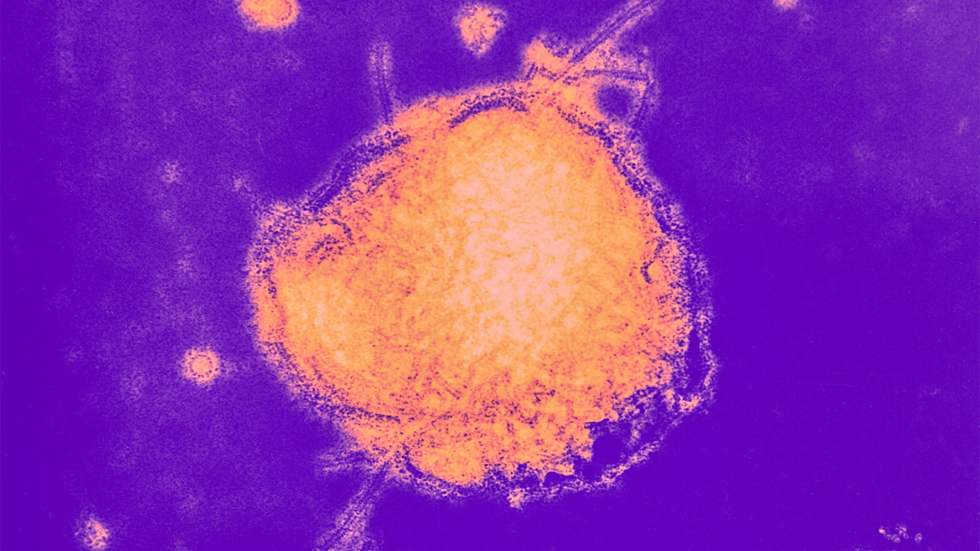 Measles outbreaks surge to top 3,500 cases this year: These tracker maps show the areas hardest hit