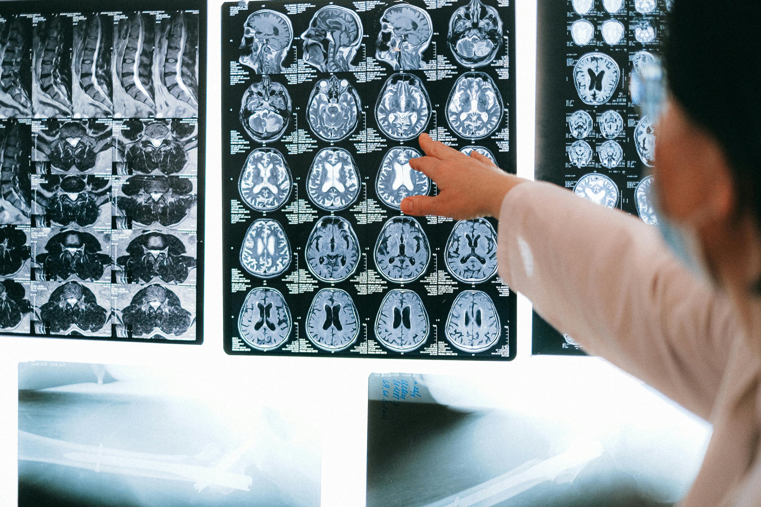 Cancer markers in spinal fluid may reveal tumors mistaken for autoimmune encephalitis