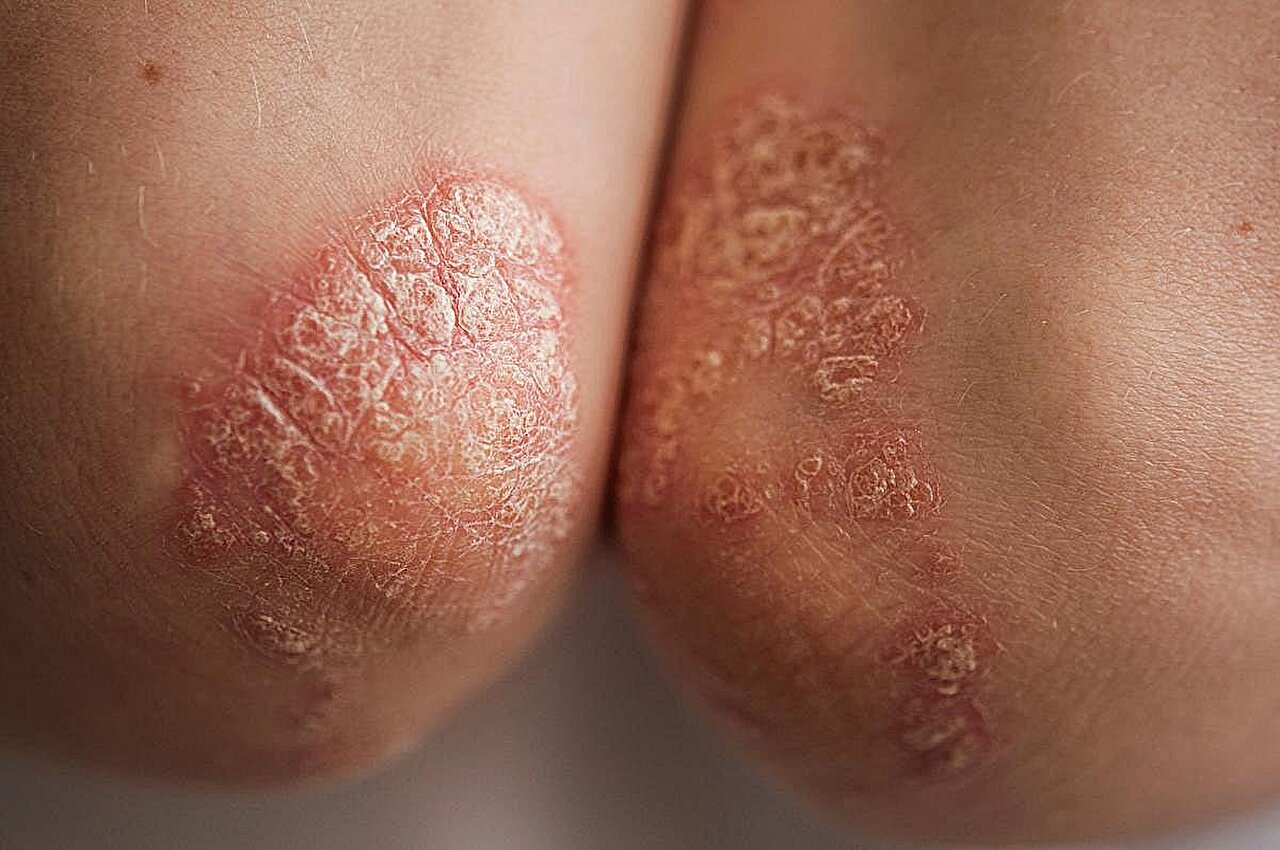 Mortality, comorbidity risk increased with generalized pustular psoriasis