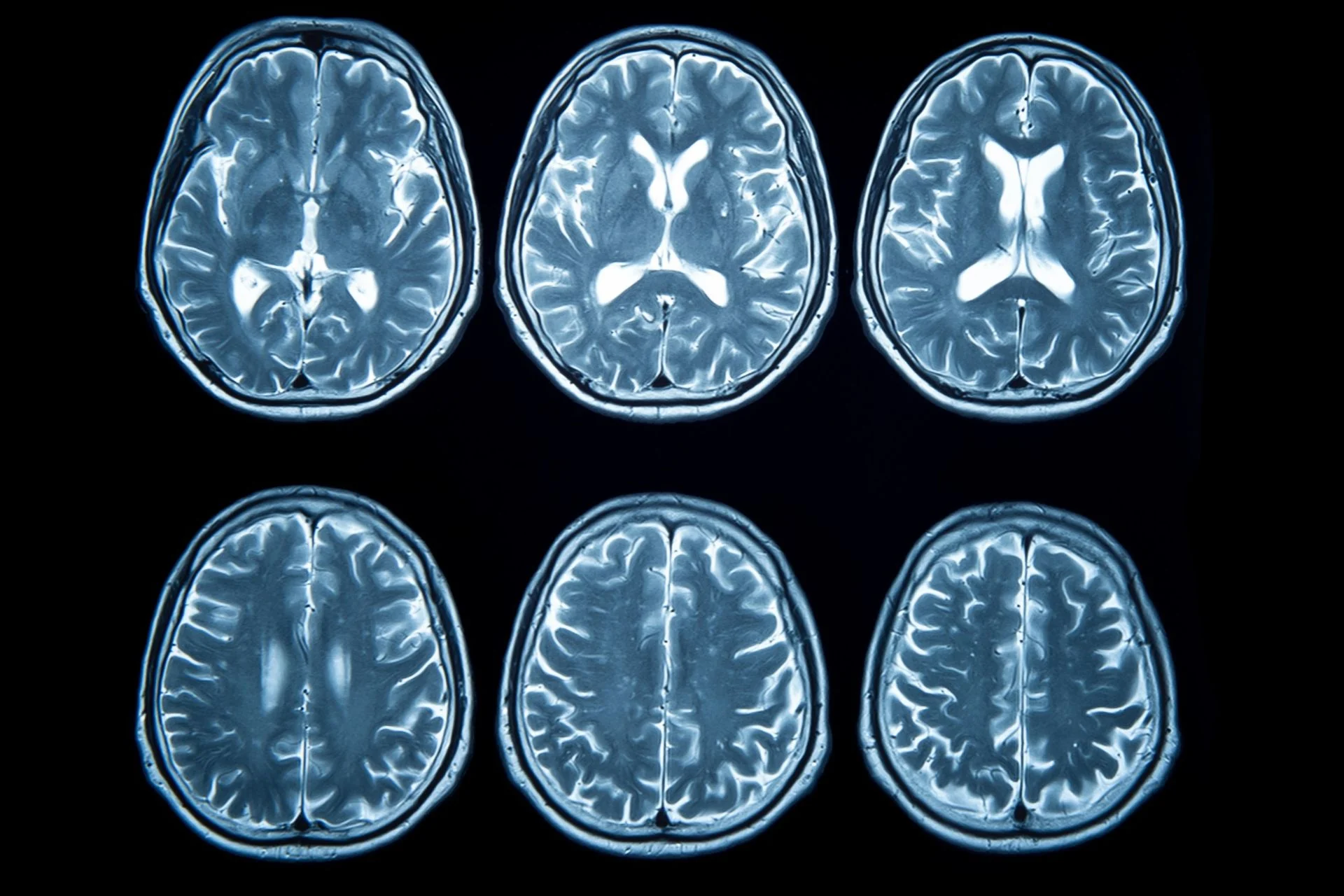 Stroke Rates in Younger Americans Have Nearly Doubled Since the 90s—and Scientists Can’t Fully Explain It