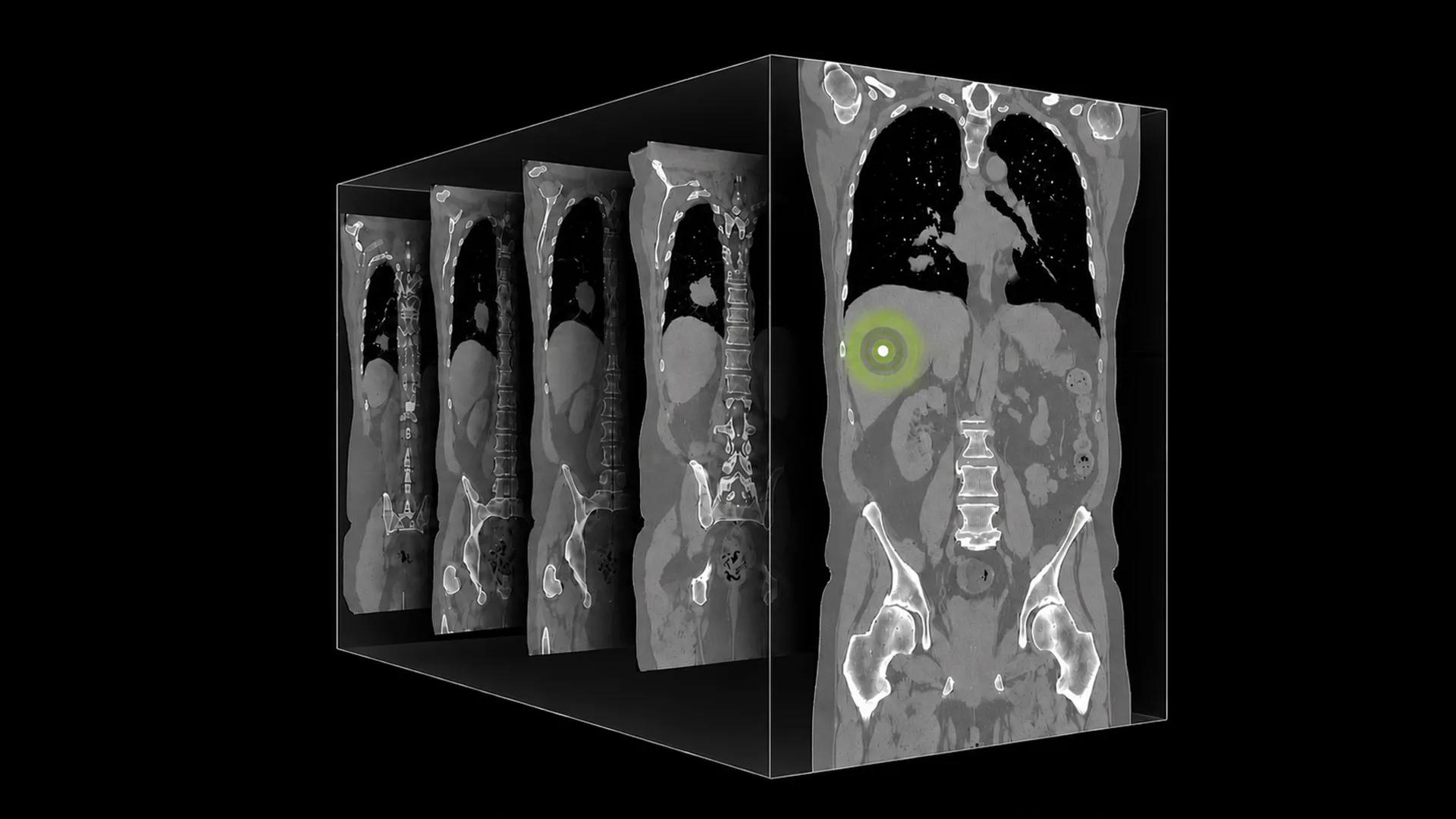 Introducing NV-Reason-CT Open 3D CT VLM for Radiologist Chain-of-Thought Reasoning