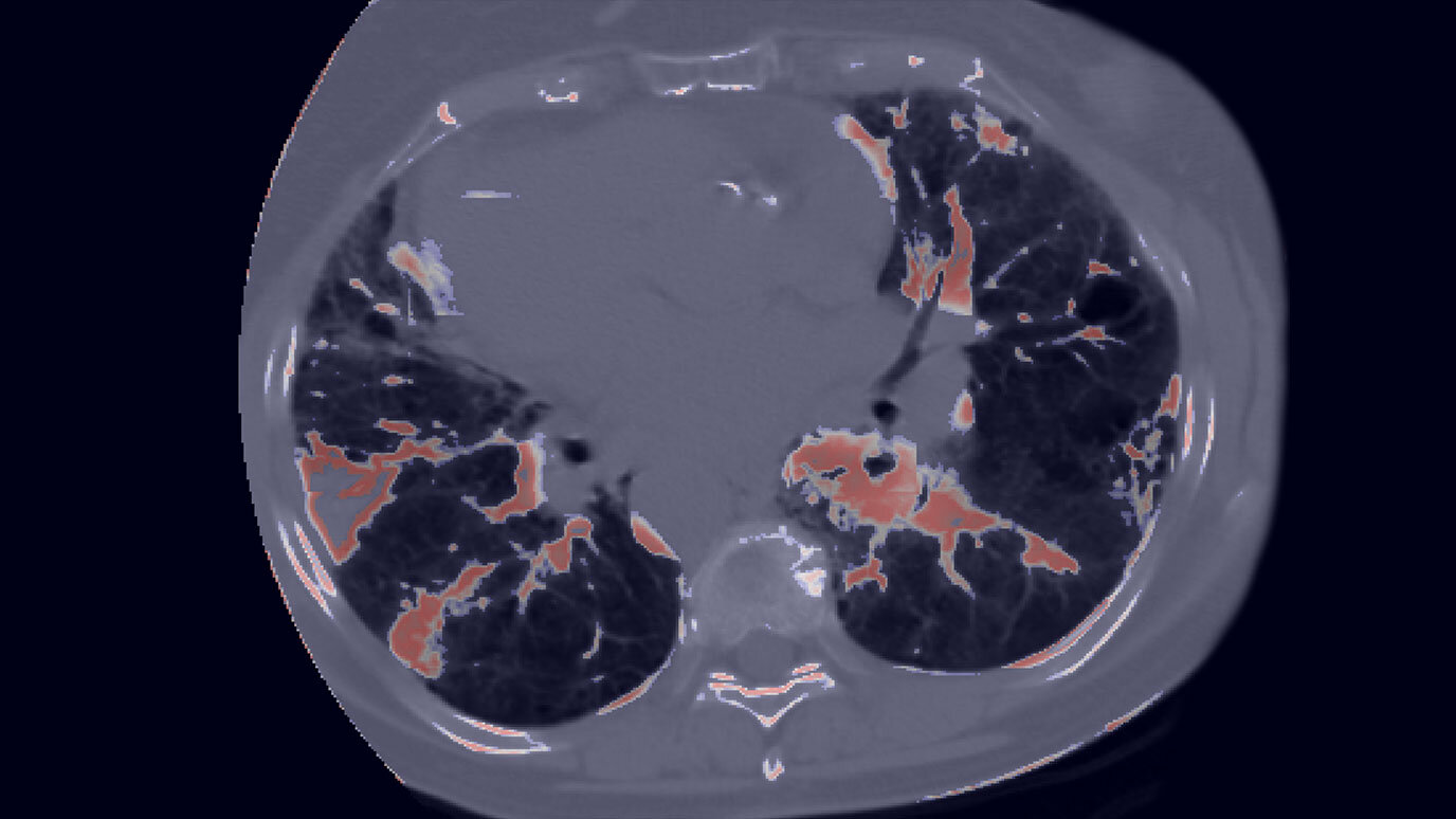 AI model uses routine imaging to identify patients at risk for serious treatment-induced lung inflammation