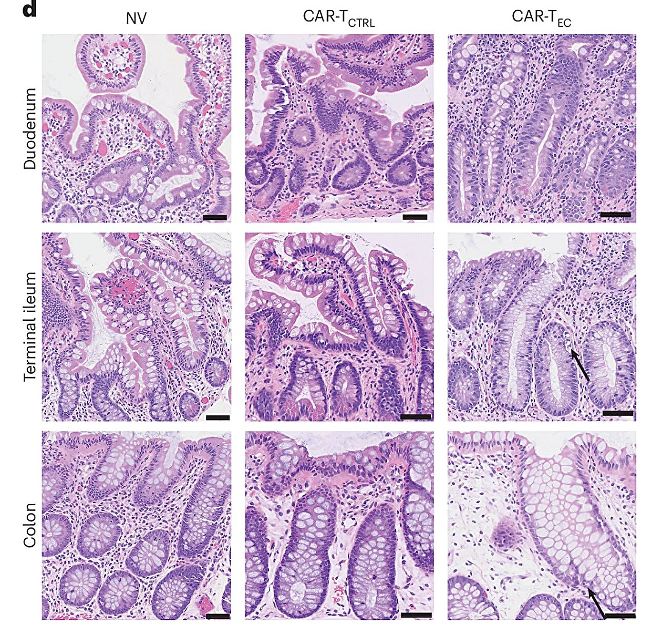Why some patients may develop severe intestinal inflammation after CAR-T therapy