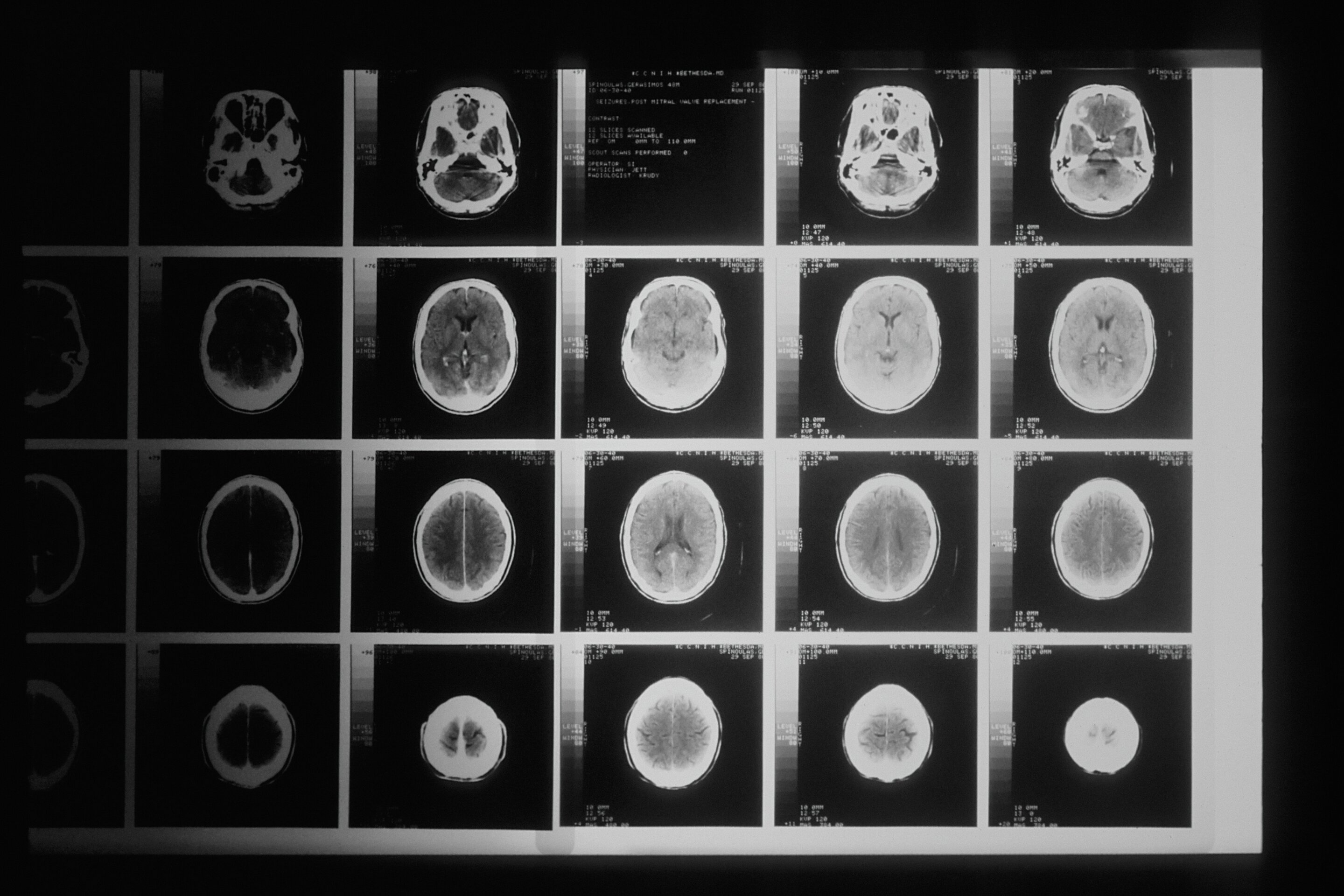 New brain tumor test could transform diagnosis and treatment