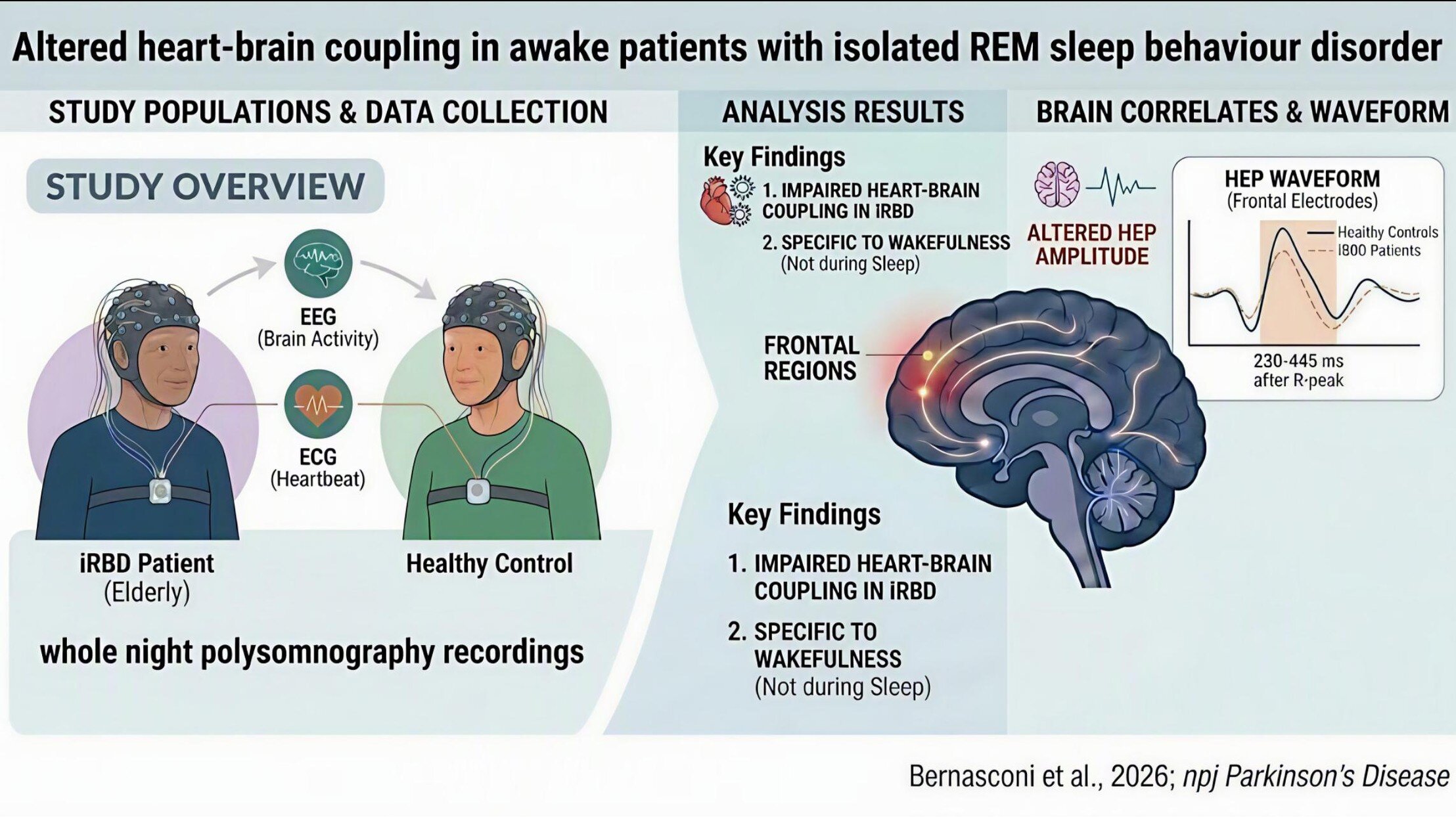Brain responses to heartbeat are altered in patients with iRBD