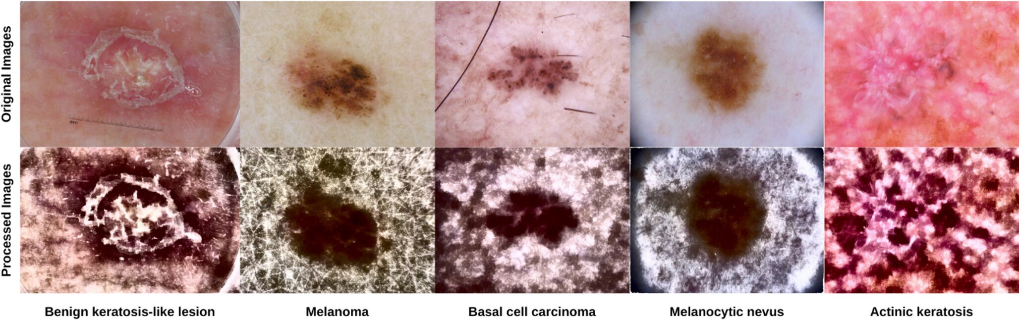 AI tool designed and integrated into hospital workflows to classify skin lesions