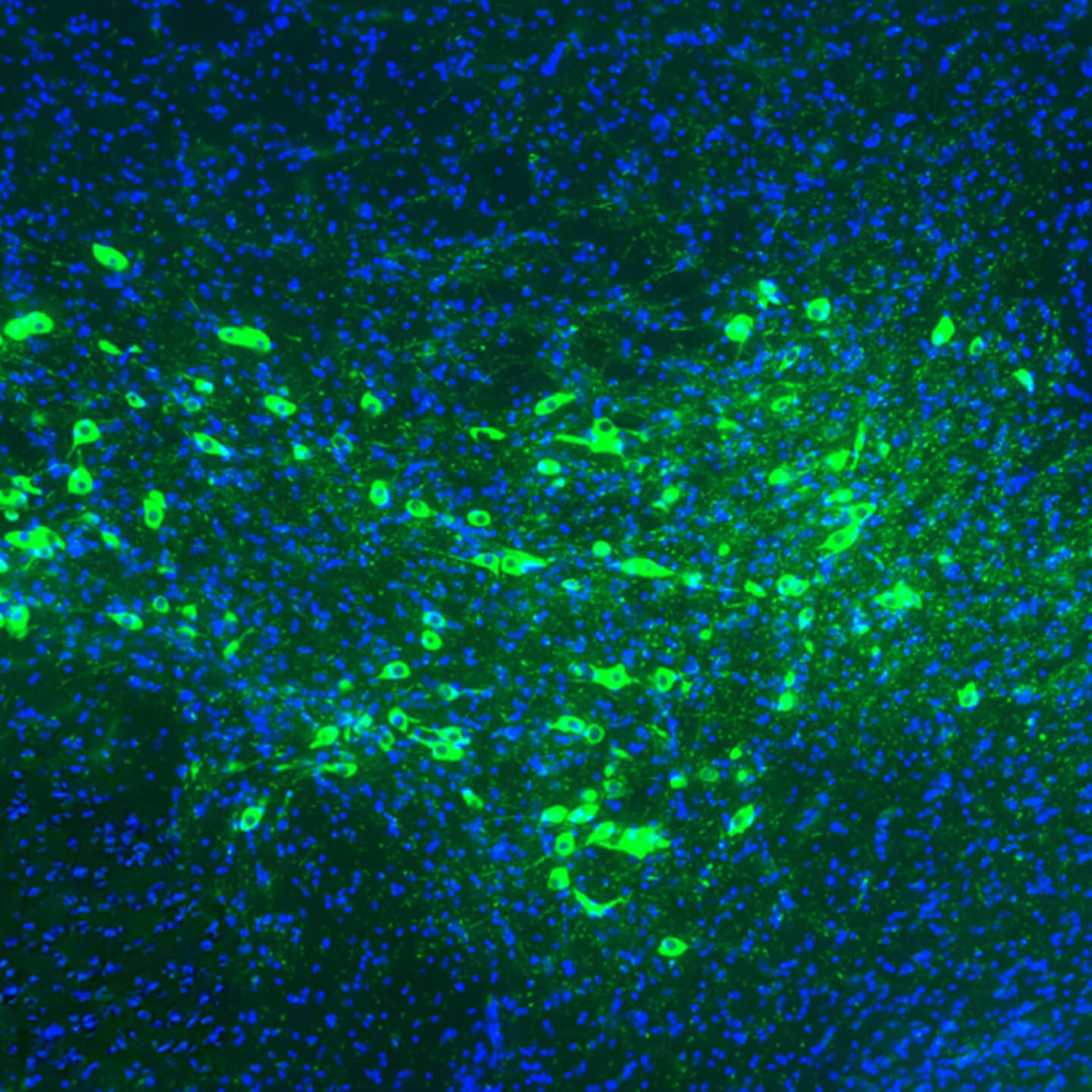 Managing misfolded proteins to prevent Parkinson's disease