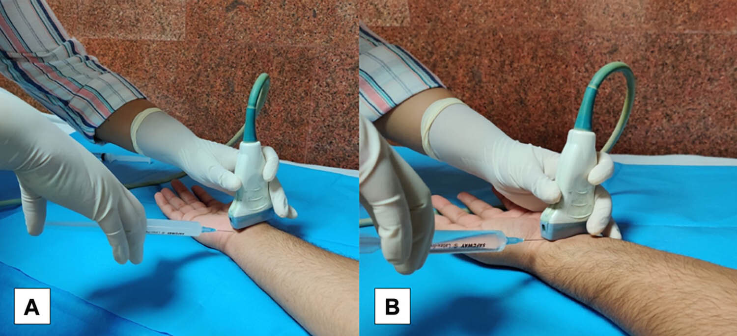 Minimally invasive technique offers lasting relief for carpal tunnel syndrome
