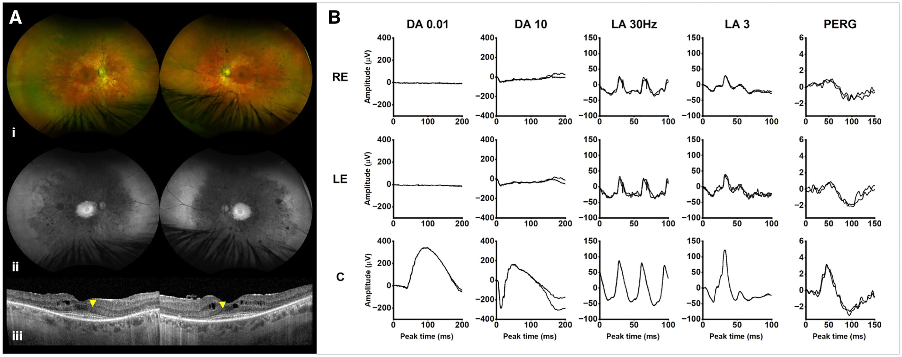 Unexpected link identified between rare metabolic disease gene and inherited blindness