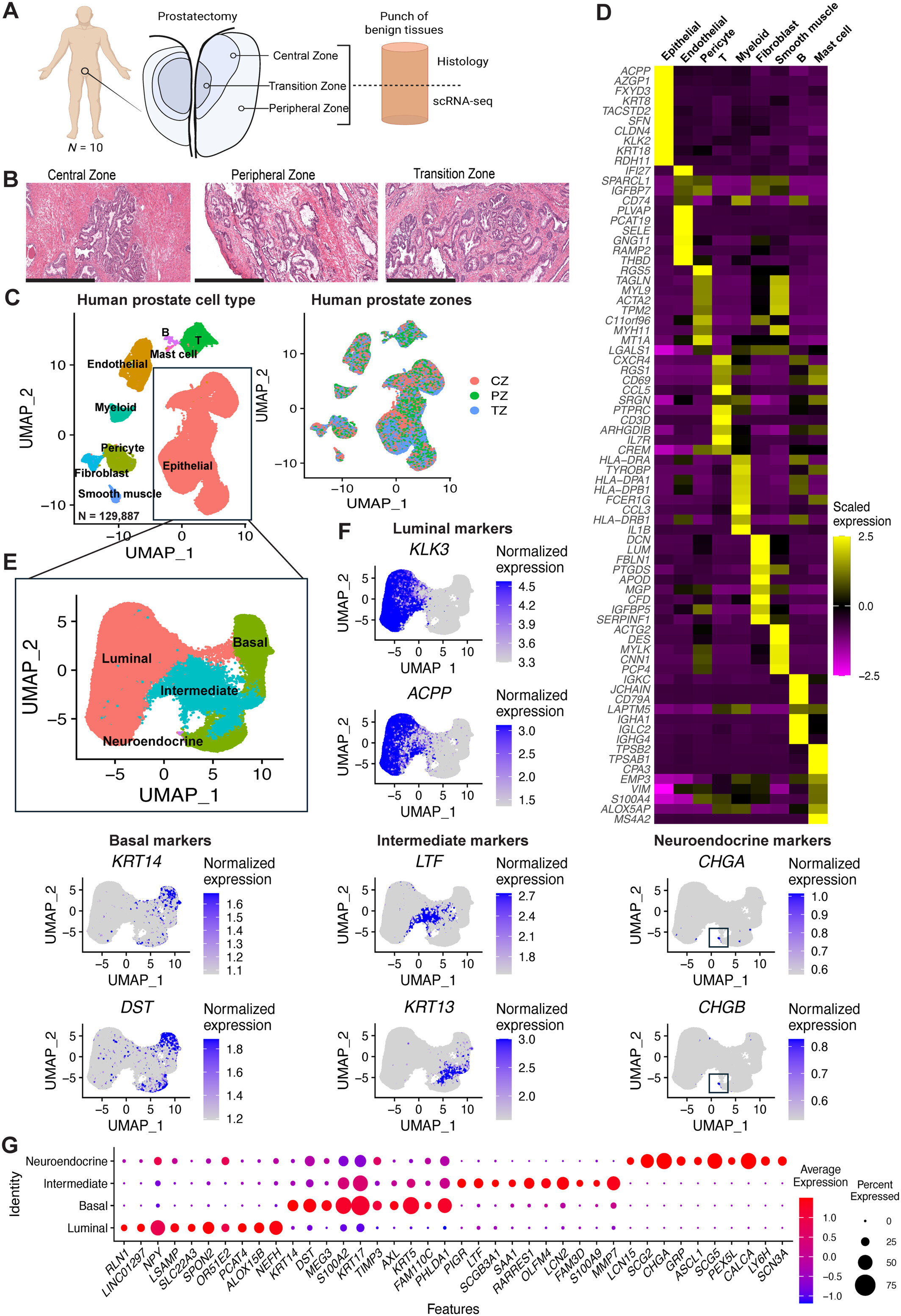 Newly identified prostate cell type may help explain why enlarged prostate develops in one region of gland