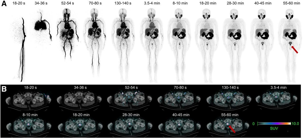 PSMA PET/CT-targeted biopsy improves detection of clinically significant prostate cancer