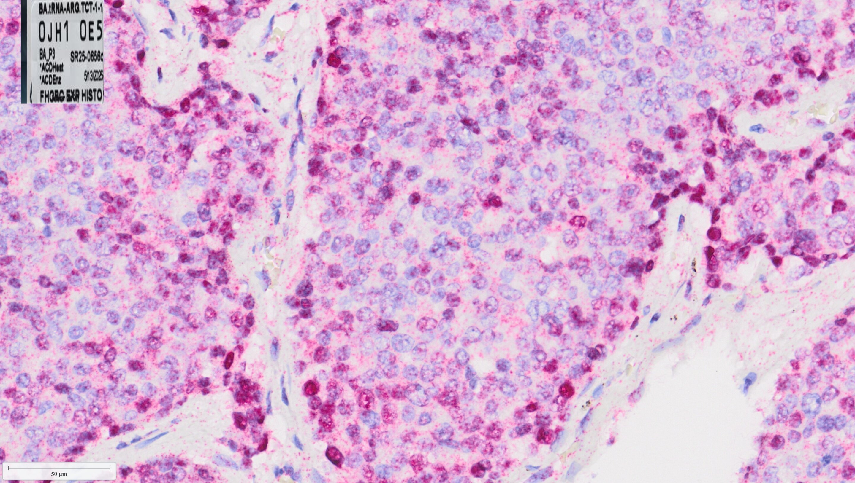 Key driver of aggressive prostate cancer identified, suggesting new way to reverse drug resistance