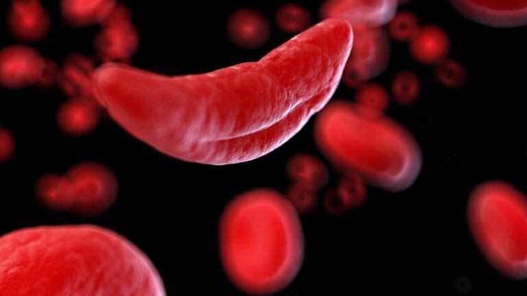 Children living with sickle cell can be treated safely using hydroxyurea, 10-year trial finds