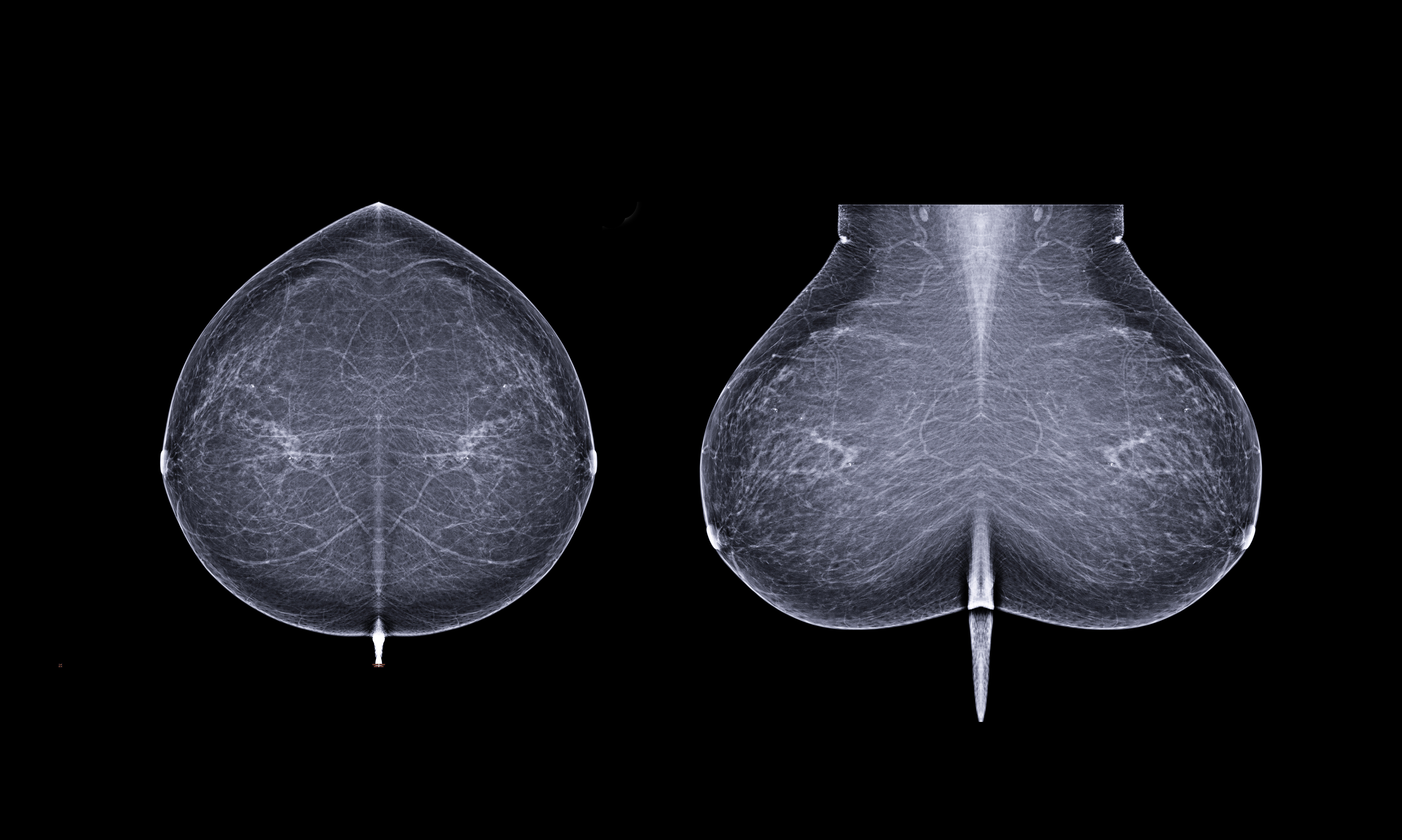 STAT+: Why this startup is taking its AI to predict breast cancer risk directly to patients