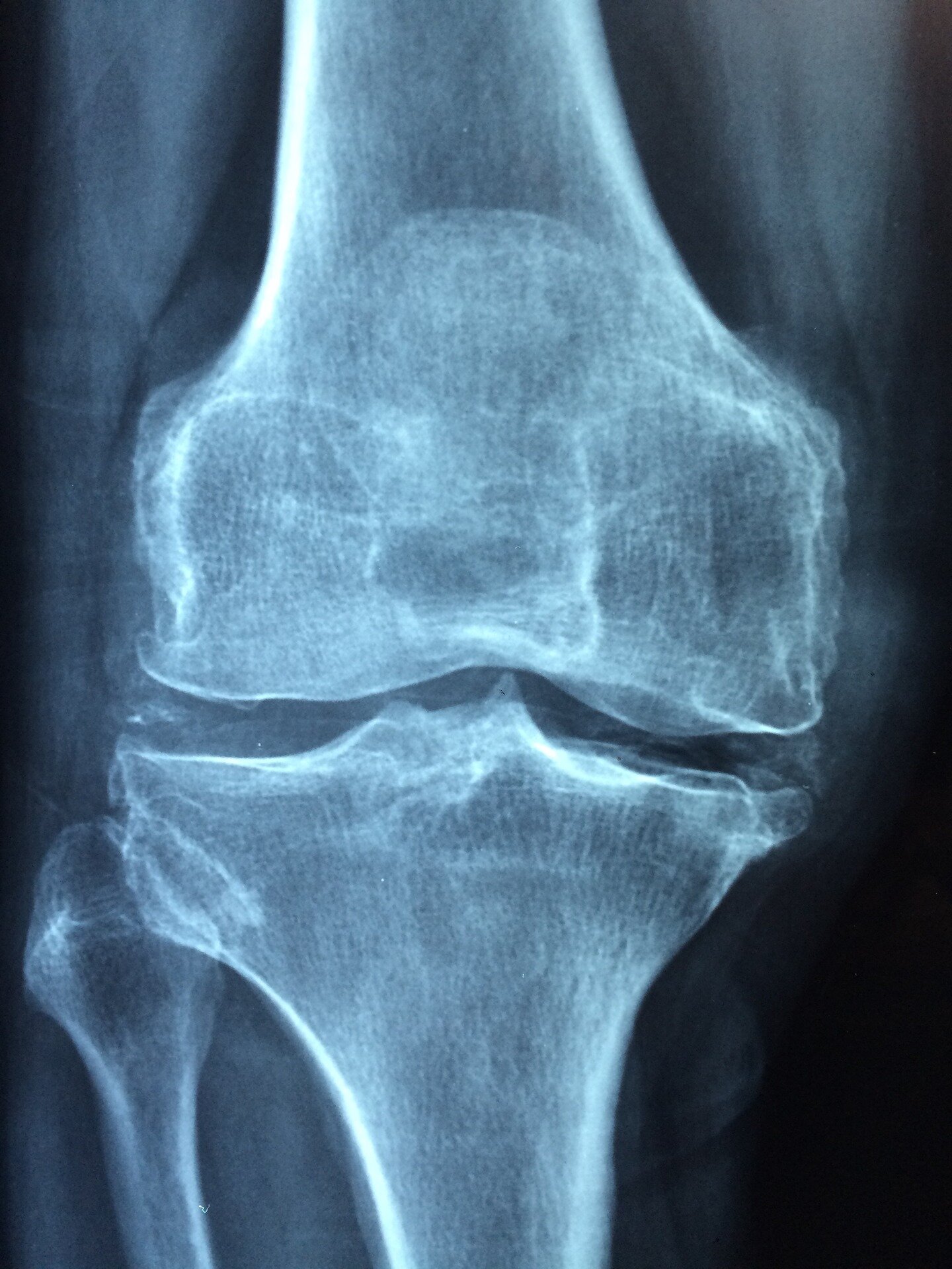 Q&A: How FDA decision is speeding development of new osteoporosis drugs