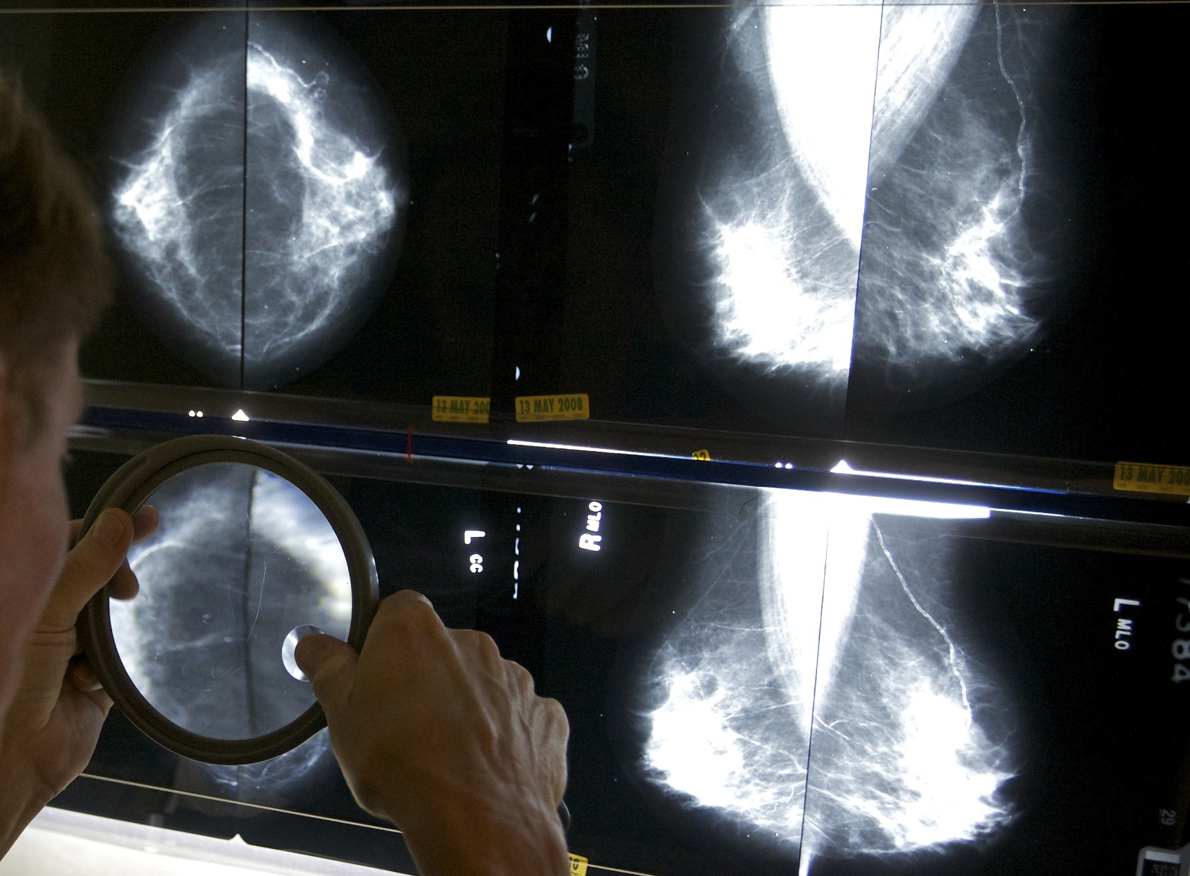 STAT+: AI for breast cancer risk prediction goes DTC, regulatory cloud over Utah sandbox, and AI psychosis