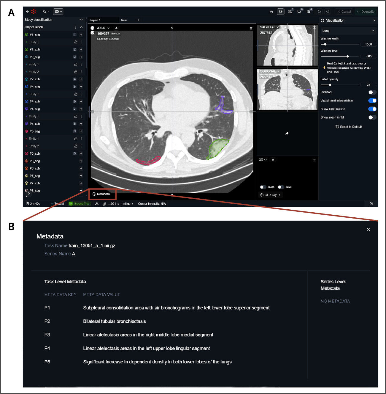 Public dataset aims to teach AI to 'show its work' on CT scans