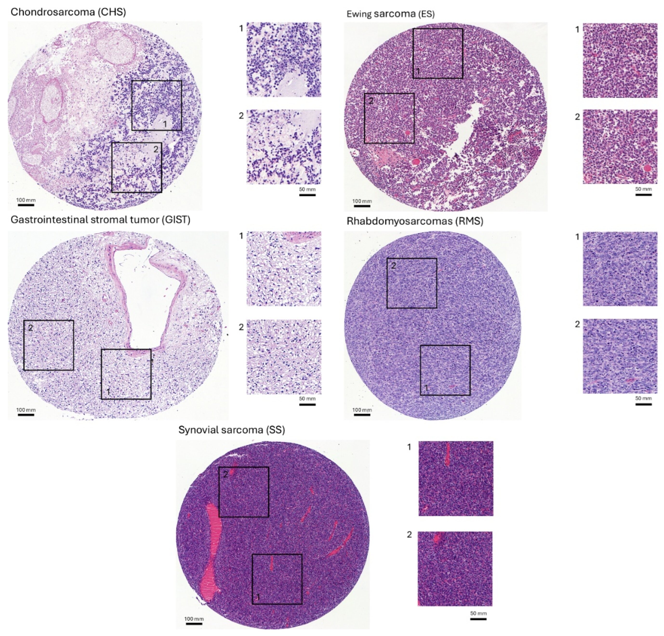 A new AI tool distinguishes Ewing sarcoma from similar tumors