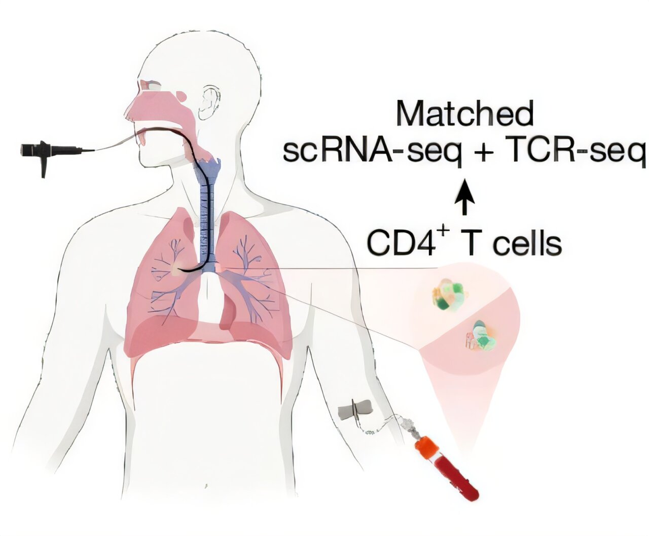 'Immune fog' may flag lung cancer risk years before tumor develops