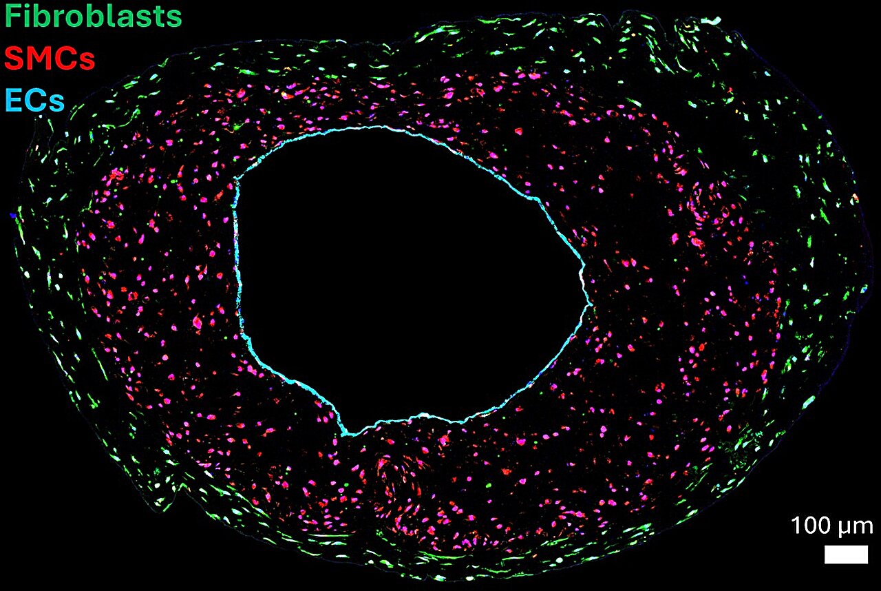 Lab-grown blood vessels reveal roles of different cells in rapid-aging disease