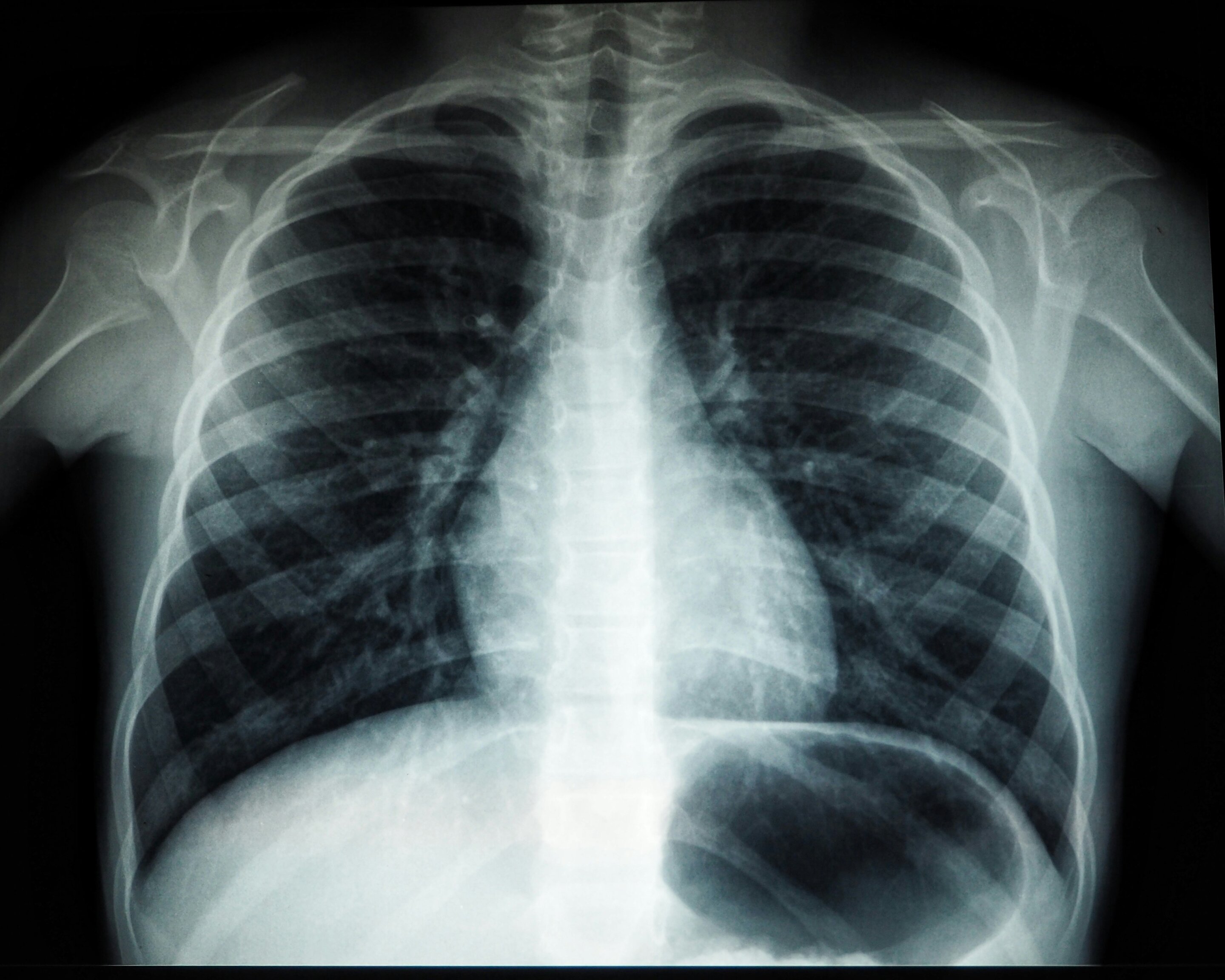 The pope has a lung nodule. What does this mean? And what's the risk of cancer?