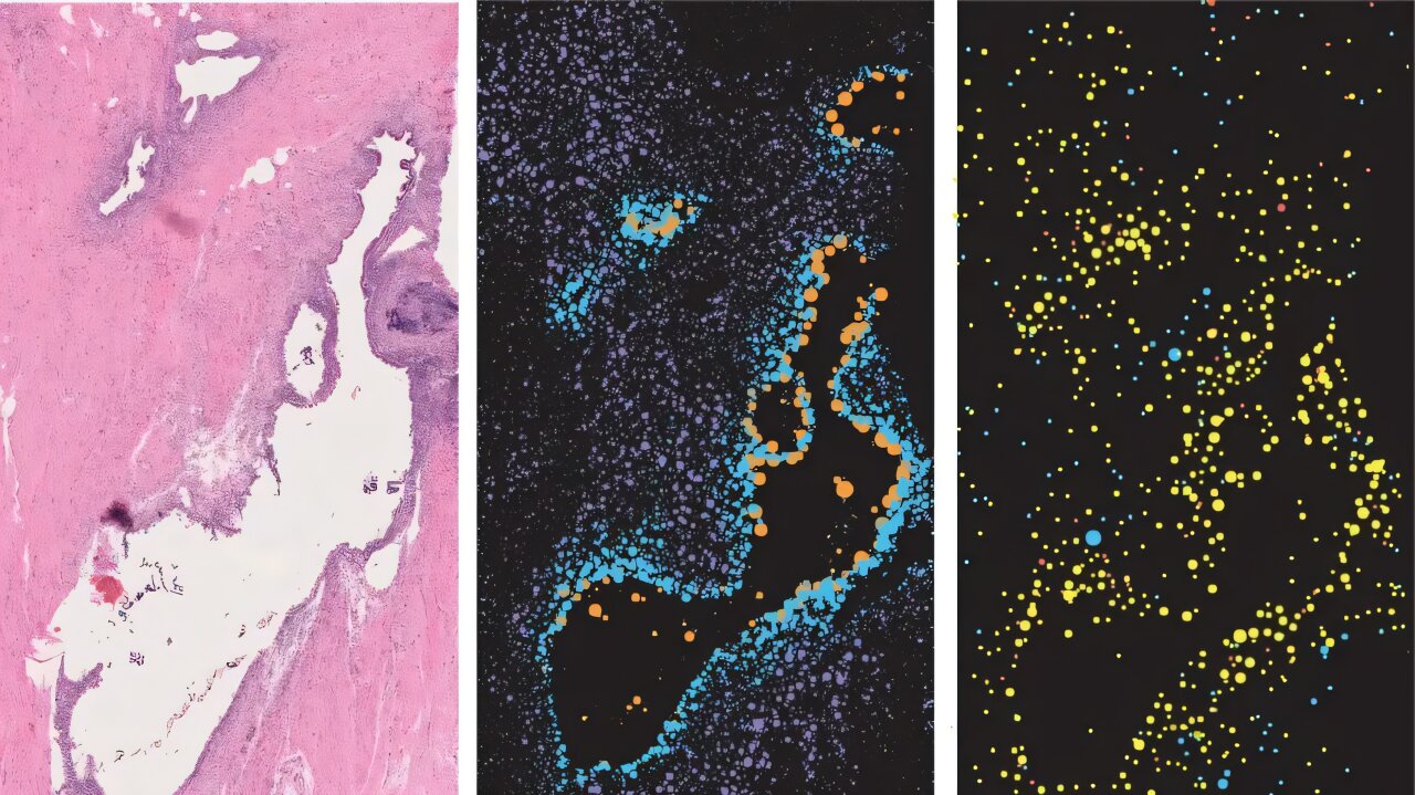 A closer look at endometriosis pain: New map reveals key cellular interactions