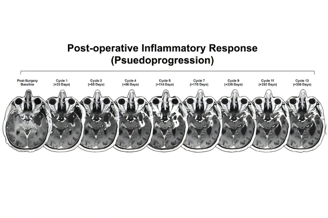 Scientists identify clues to making immunotherapy more effective against glioblastoma