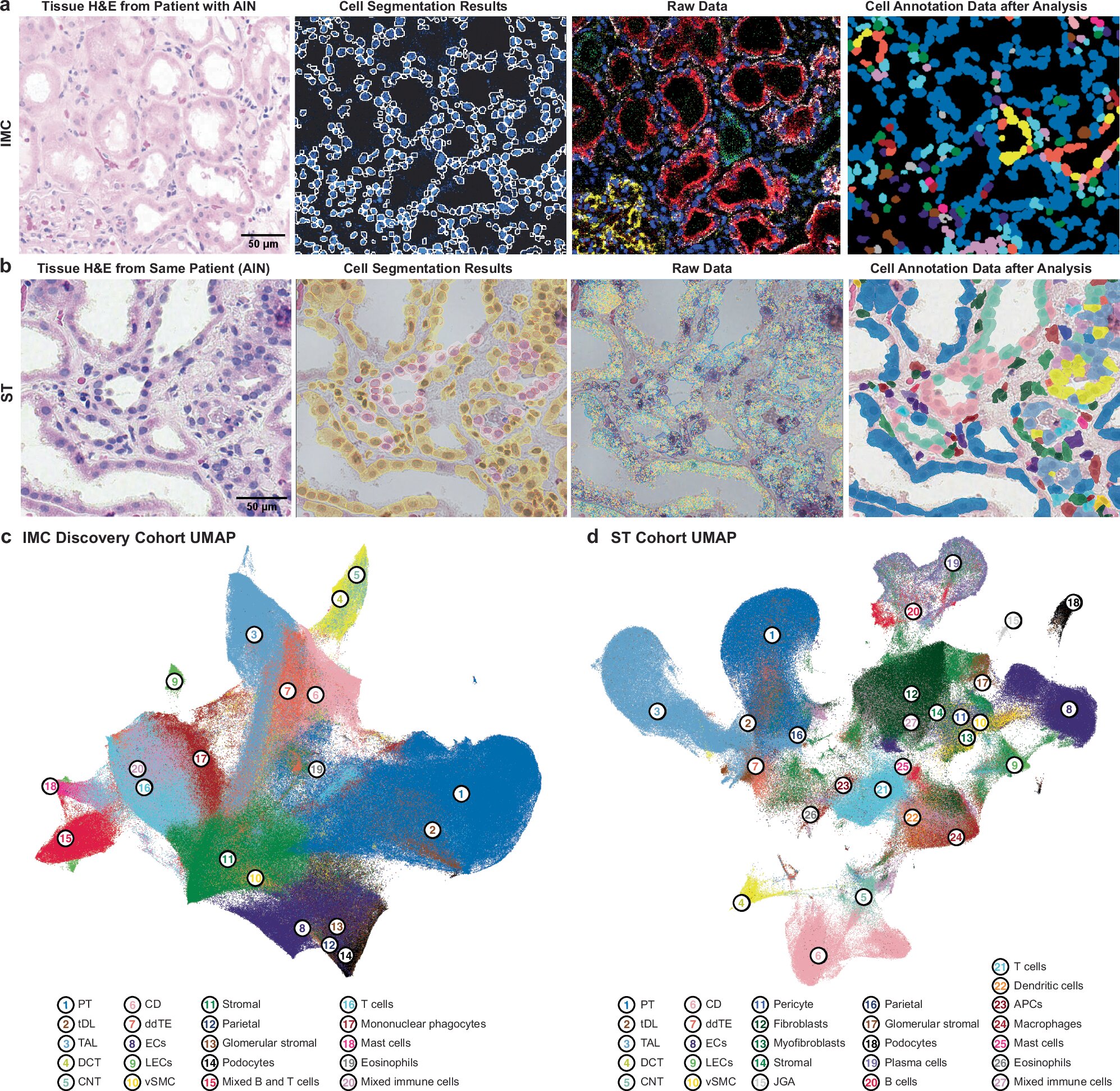 Kidney biopsy maps reveal immune clusters that may keep inflammation going
