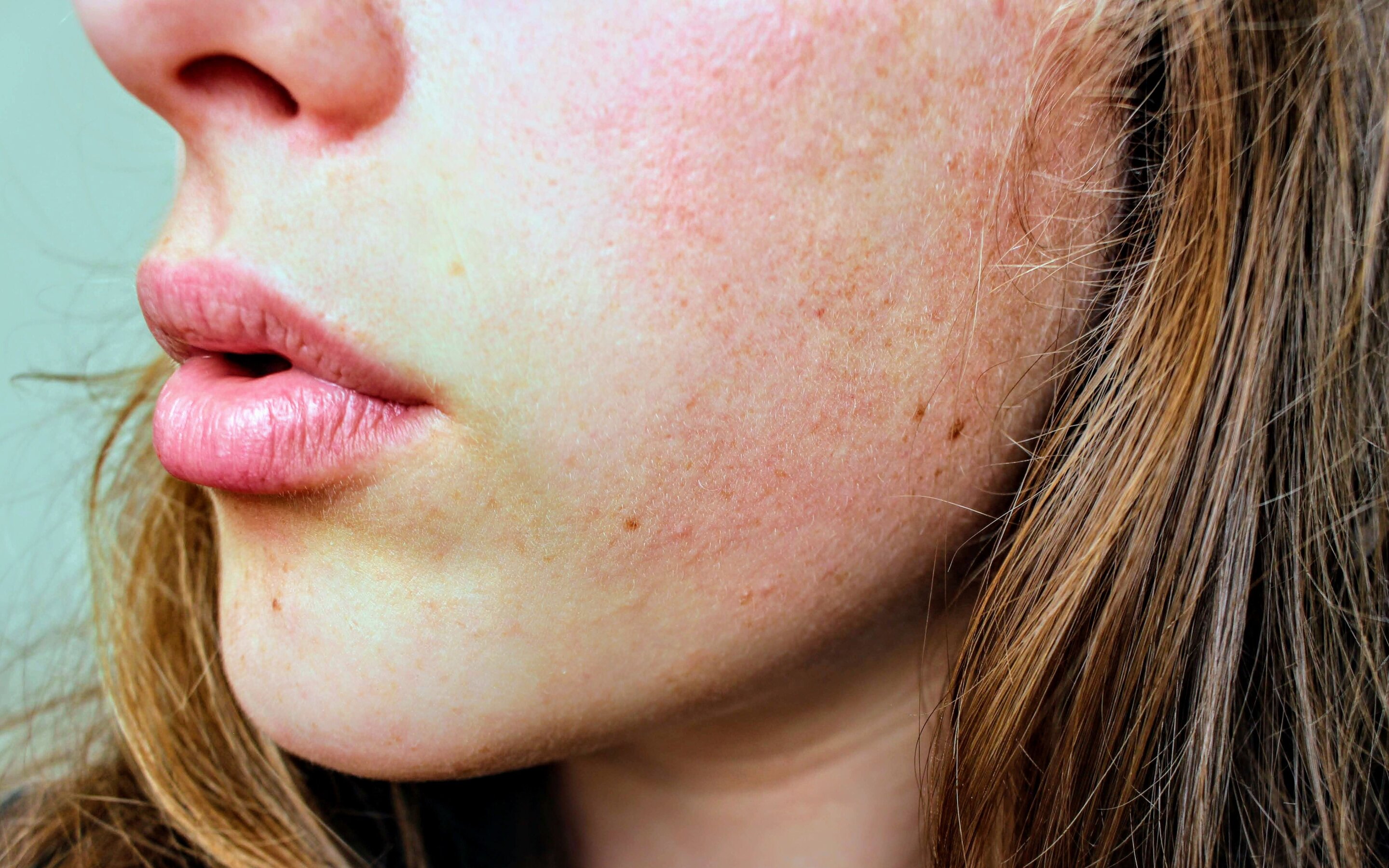 Active acupressure offers clinical benefits for rosacea