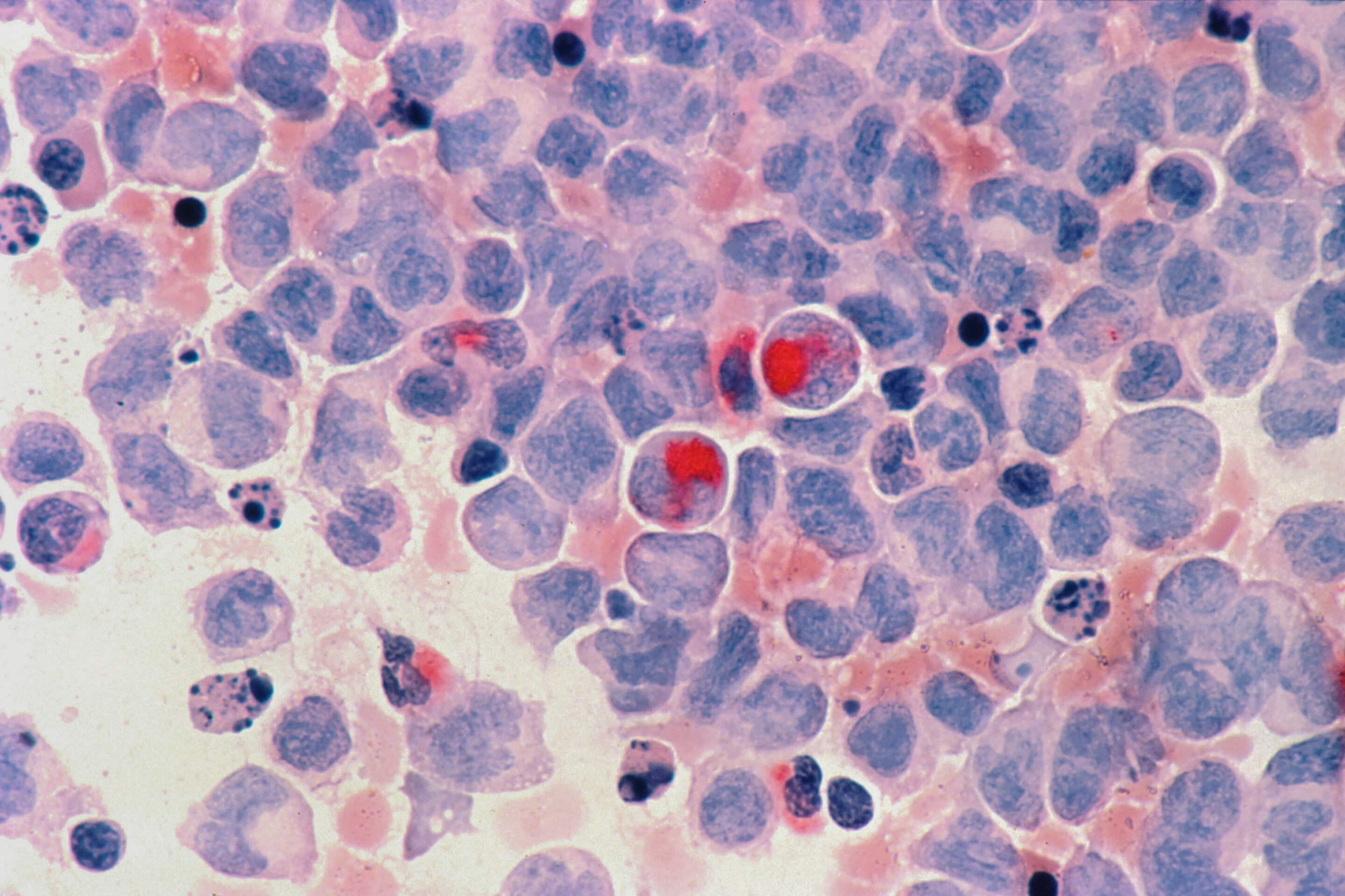Common leukemia mutation derails protein positioning during cell division, study reveals