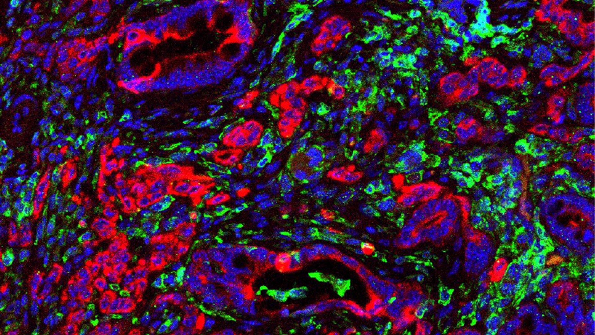 Cancer-promoting protein also helps engineered immune cells fight tumors in lab tests