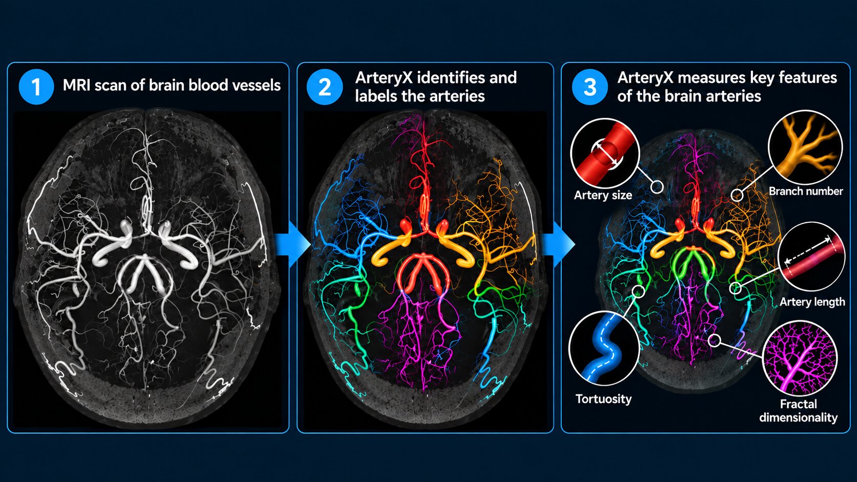 MRI analysis tool reveals brain artery differences missed by older software