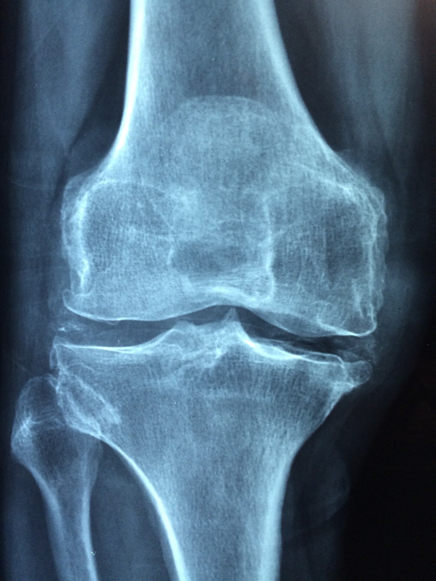 Can we take the STING out of bone loss? Pathway presents potential treatment target for skeletal aging