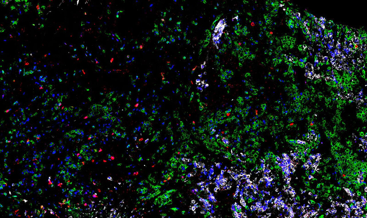 Lab-grown tumors reveal immune cells capable of killing small cell lung cancer