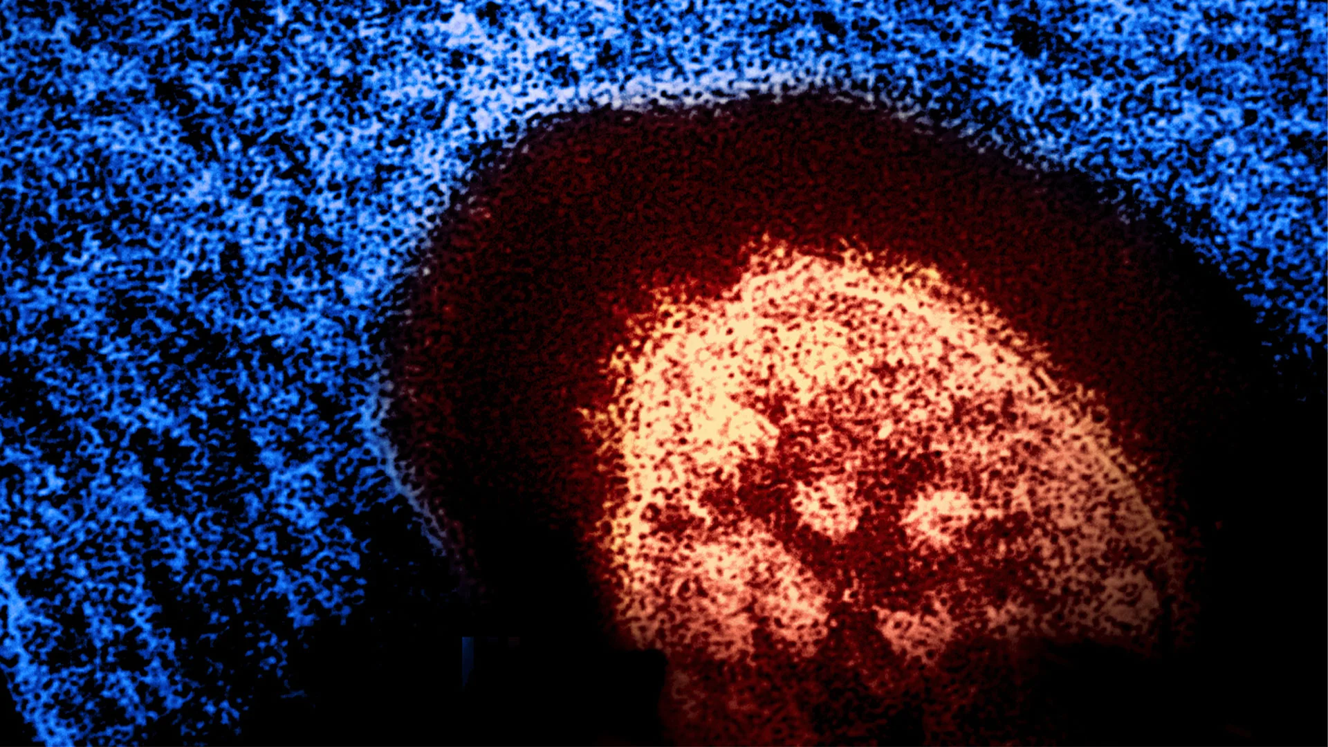 The U.S. eliminated measles 26 years ago. Now it could lose that status in a matter of weeks