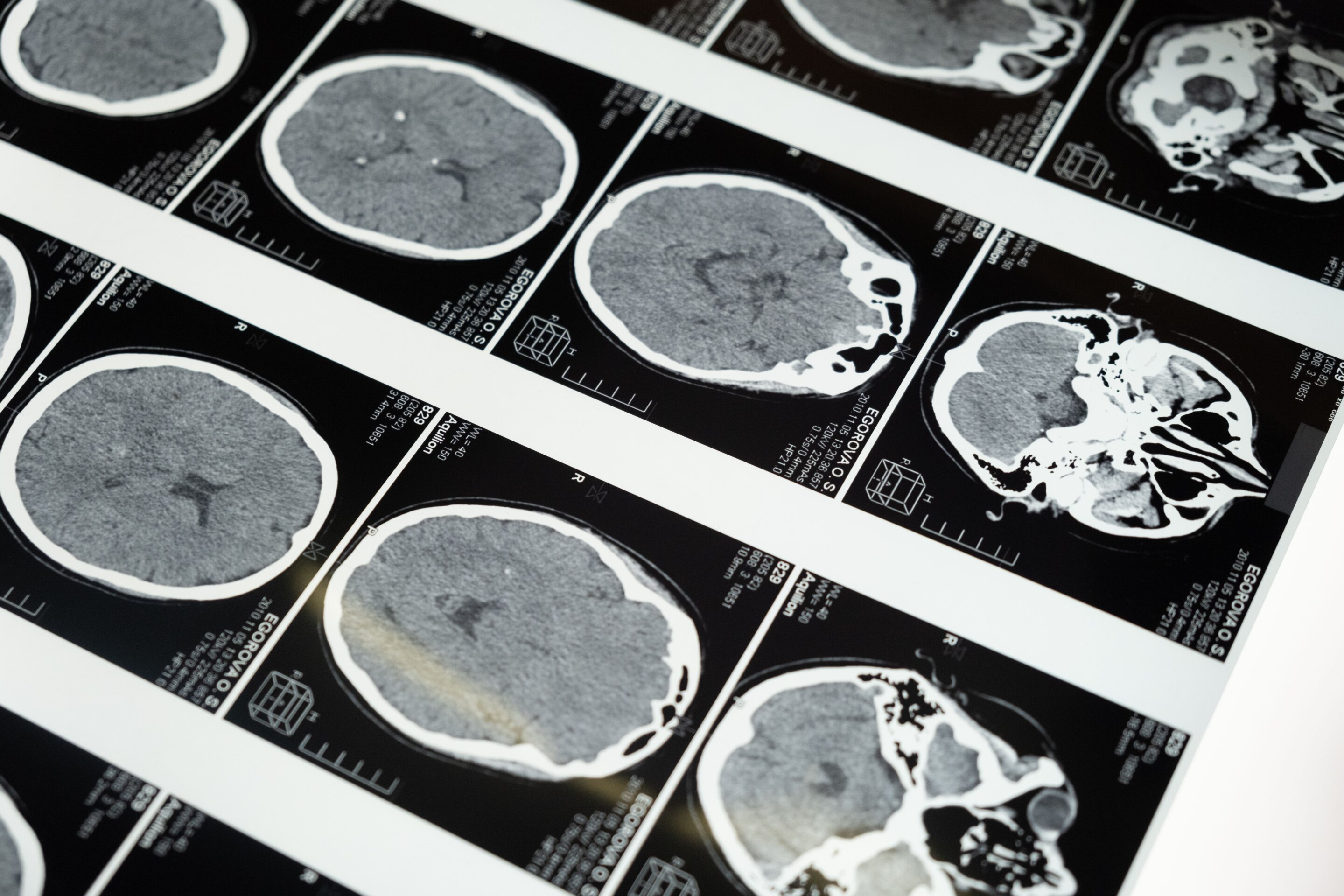 Researchers develop new AI tool to better predict stroke risk