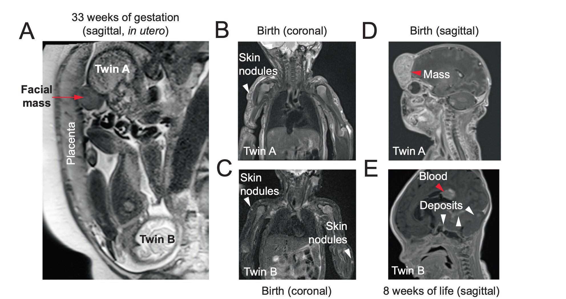 DNA sequencing reveals how rare cancer spread between twins before birth