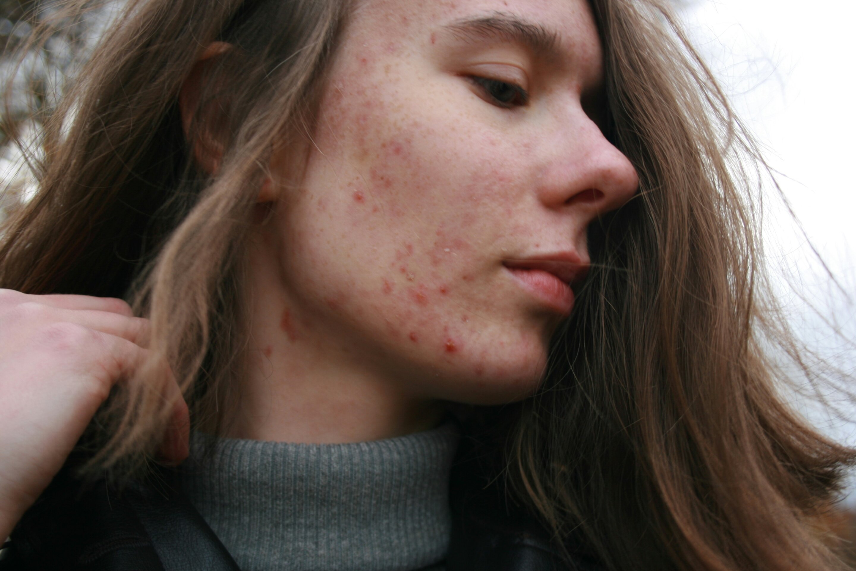 1990 to 2023 saw increase in global burden of acne
