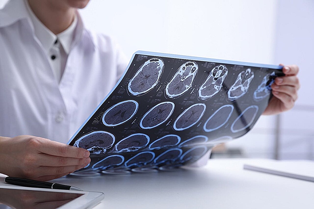 Early MS treatments impact relapses and brain scarring differently, but not disability