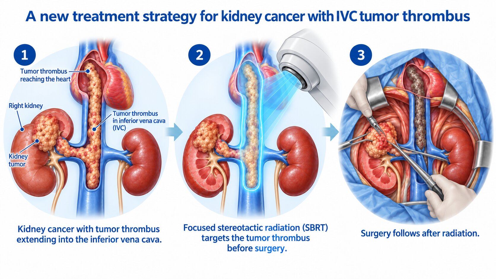Targeted radiation shows promise for life-threatening kidney cancer complication