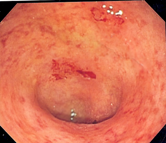 Immune changes could signal inflammatory bowel disease up to 10 years before diagnosis