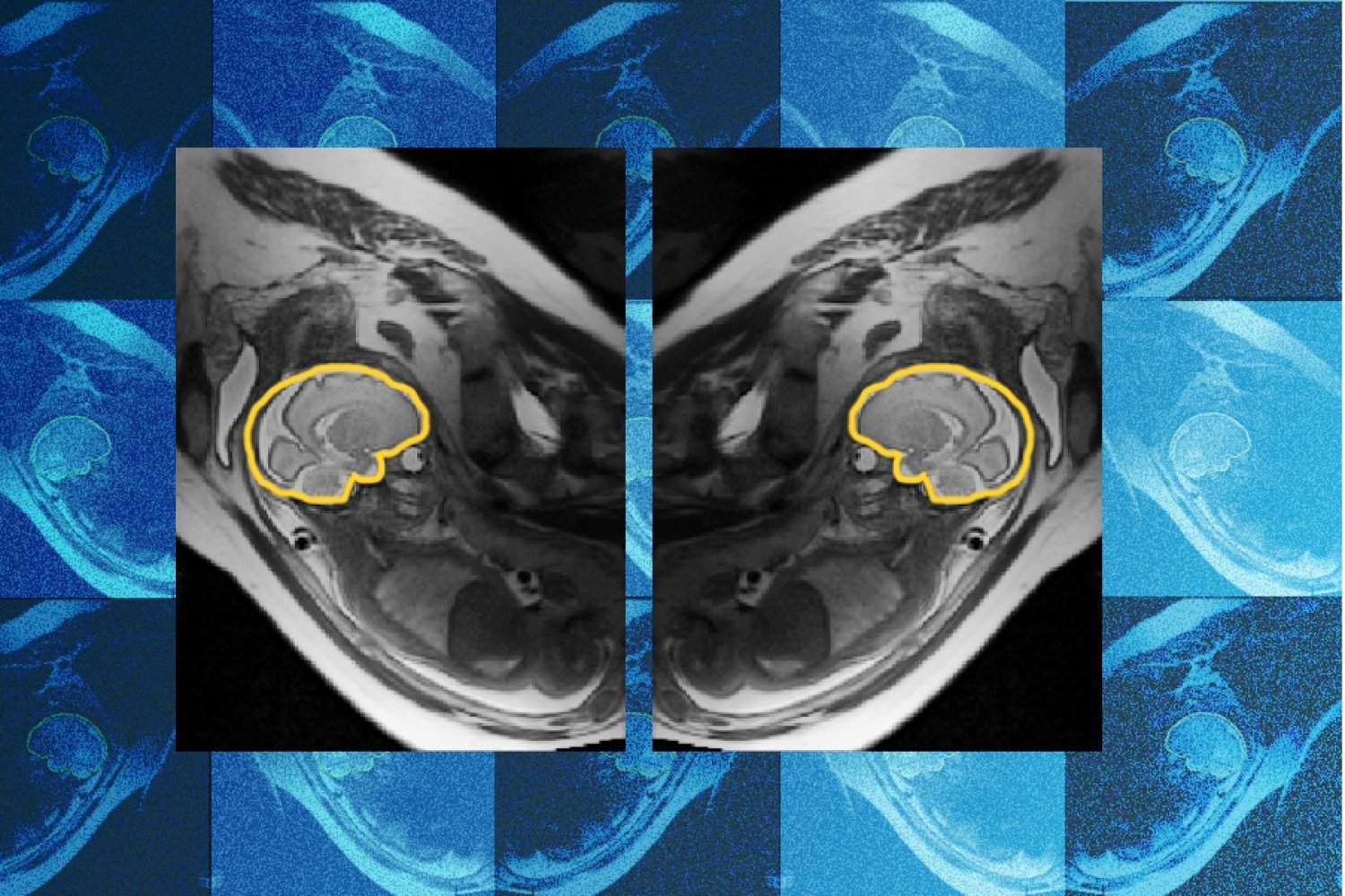 Why teaching AI about symmetry could make prenatal diagnosis more reliable