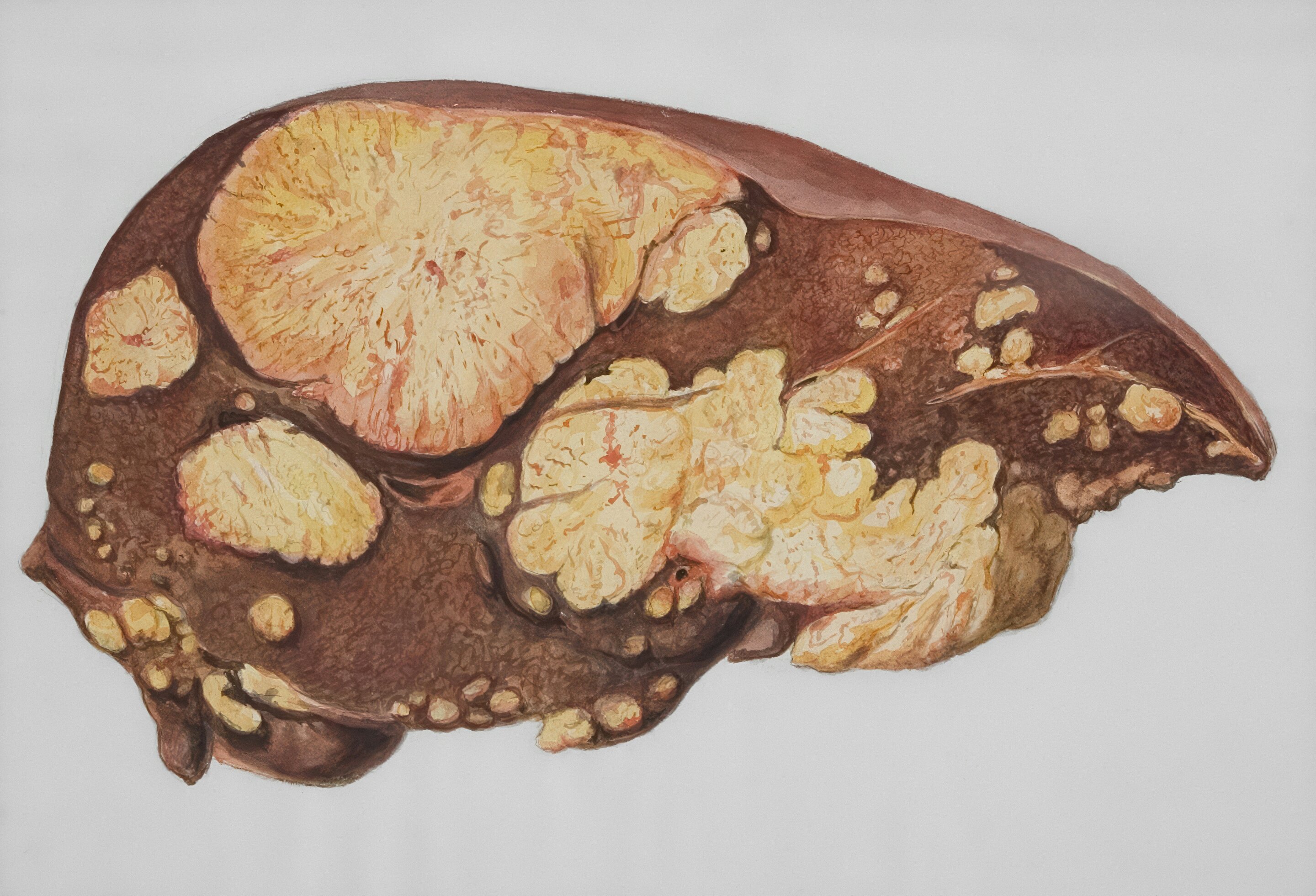 Protein discovery reveals potential treatment target for common fatty liver disease