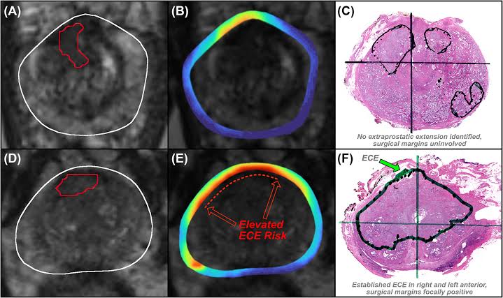 Avenda Health expands Unfold AI platform to support intraoperative prostate cancer care