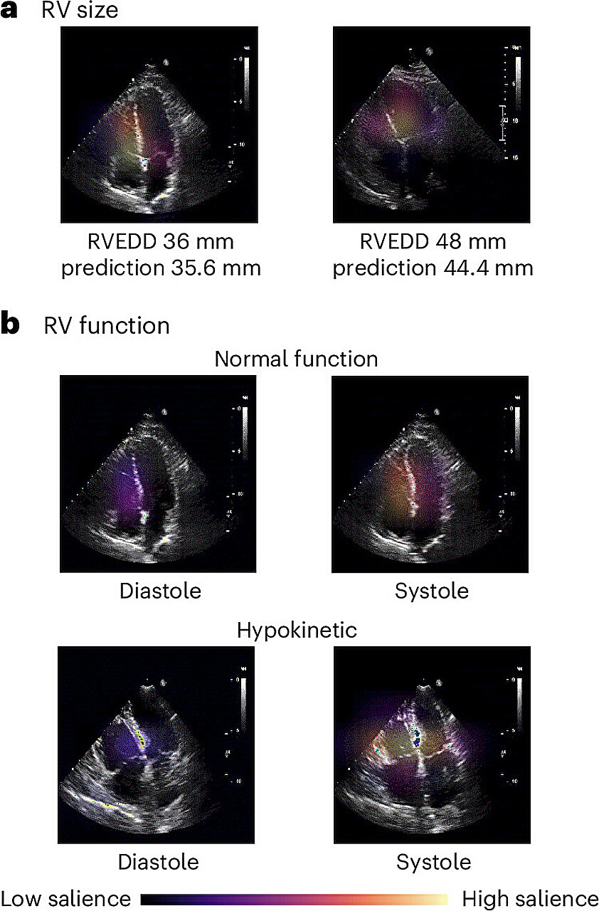 Q&A: AI tool automates echocardiogram assessment of the heart's right ventricle