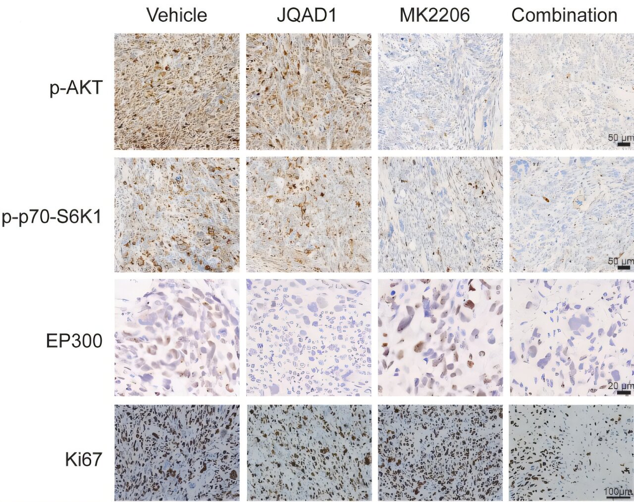 Combination therapy reveals potential vulnerability in aggressive osteosarcoma