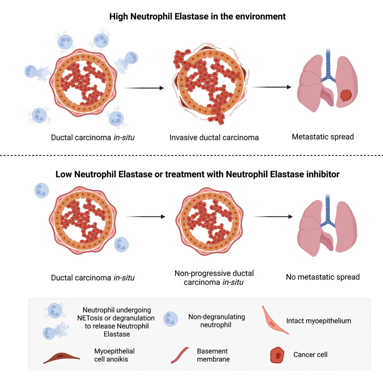 Immune mechanism discovery could help predict which early breast cancers will spread