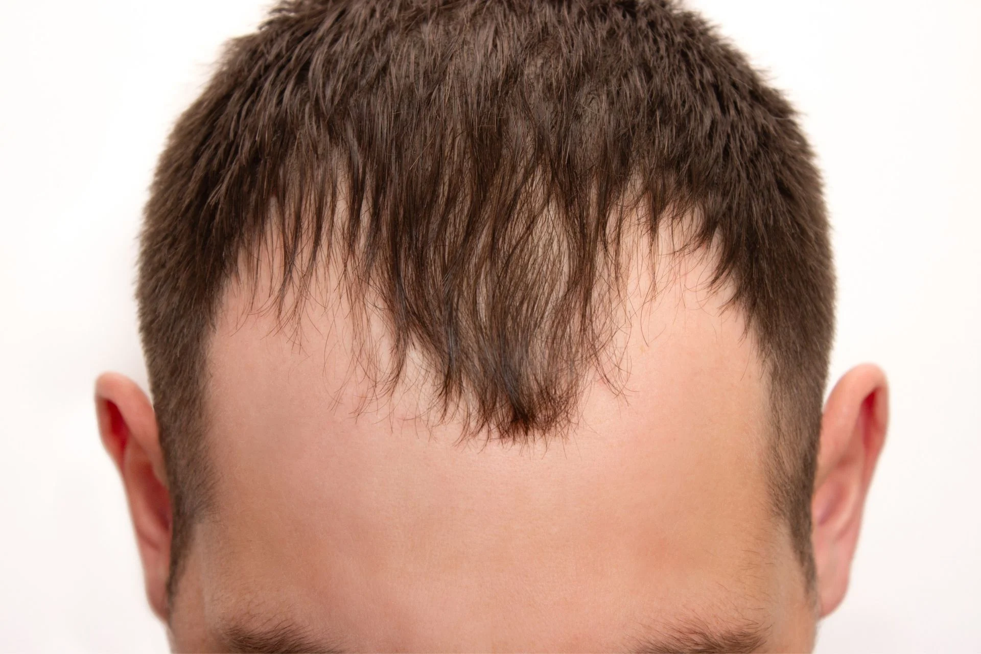 Balding Men Haven’t Had a New Pill Since the 1990s. That’s About to Change