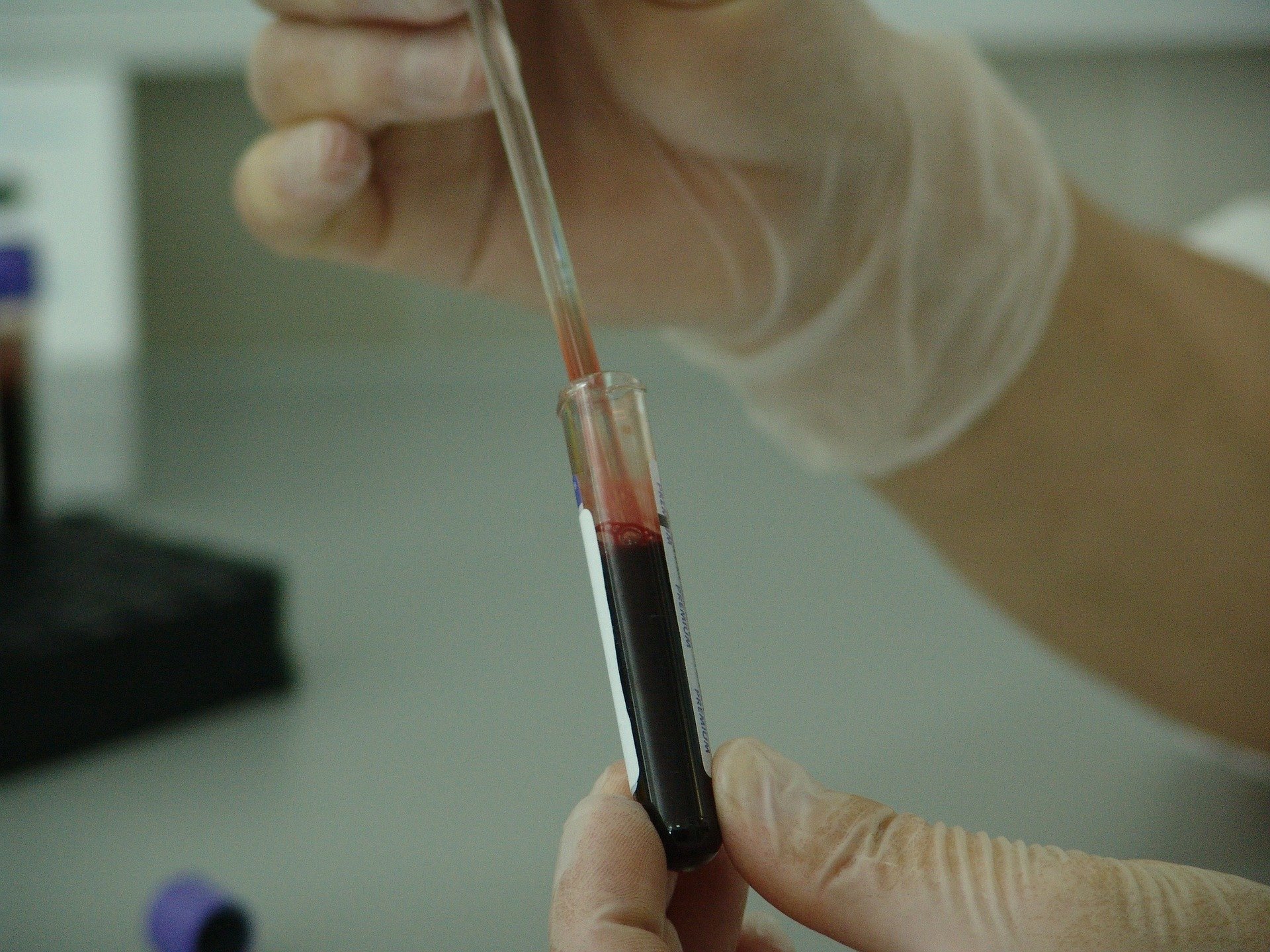 Blood proteins could reveal clues to prostate cancer risk more than a decade before diagnosis