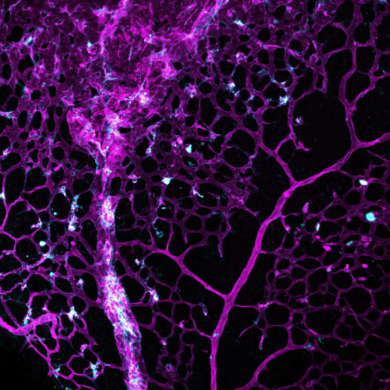 Existing cancer drug reduces blood vessel malformations in the brain